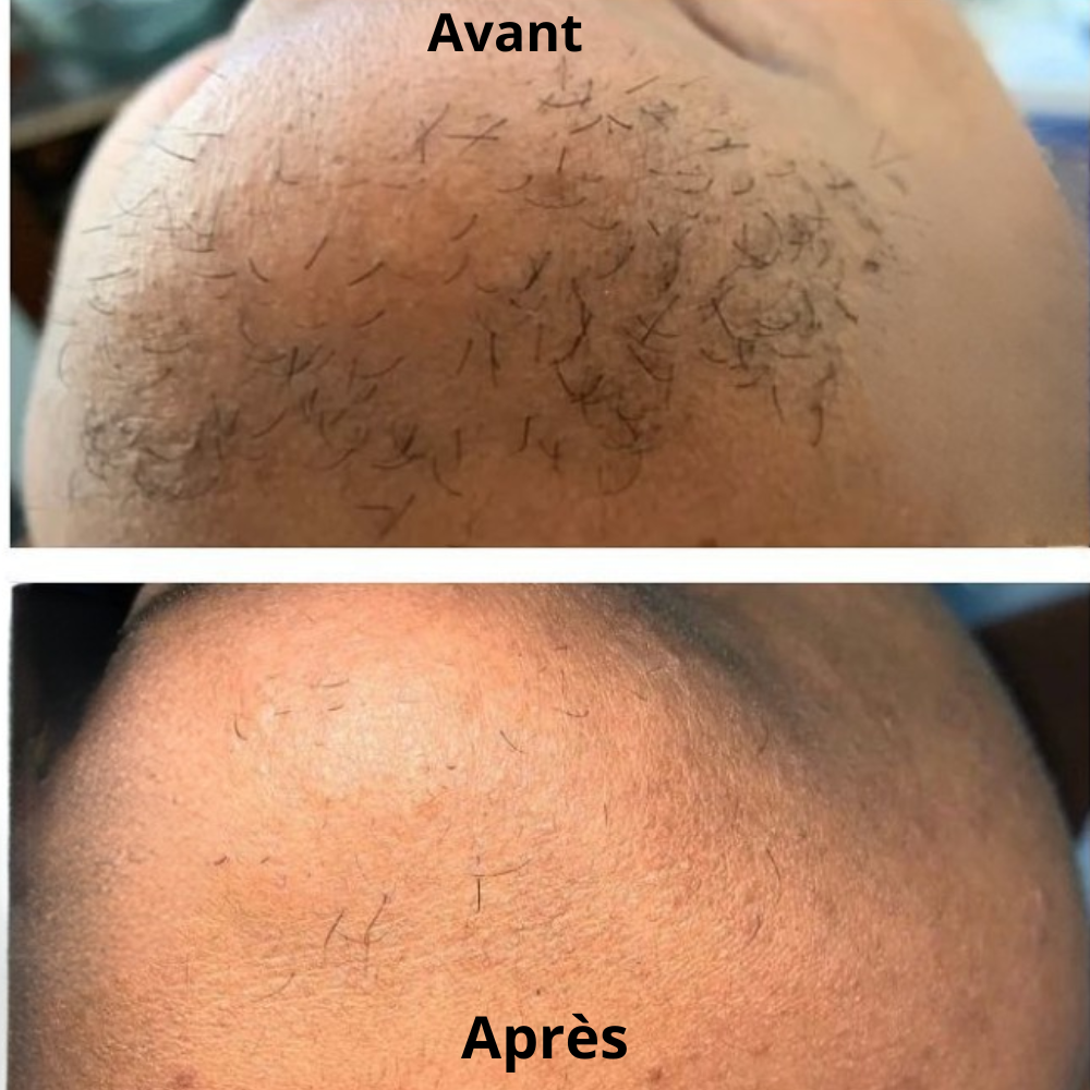 DERMYVA™ Huile visage post-épilation