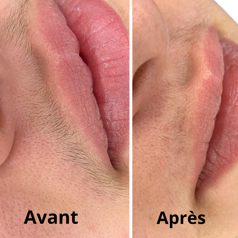 DERMYVA™ Huile visage post-épilation