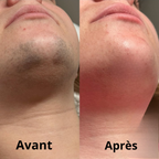 DERMYVA™ Huile visage post-épilation